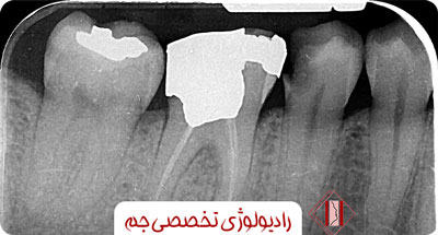 میزان اشعه رادیوگرافی های دندانپزشکی چقدر است؟