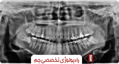 پانورکس و پری اپیکال چیست؟