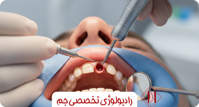 چرا بعضی ایمپلنت‌های دندانی شکست می‌خورند؟ نقش رادیولوژی دقیق